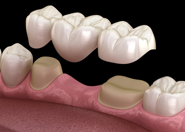 cosmetic-dentistry/crowns-bridges/