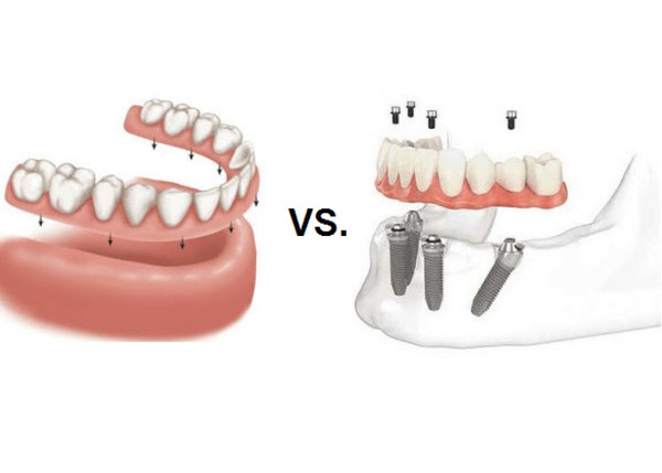 dental-implants-vs-dentures/