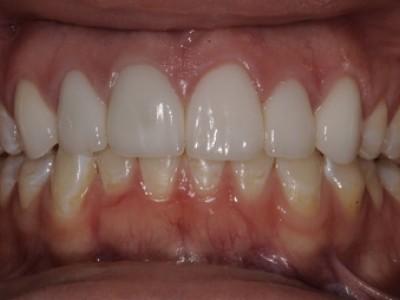 mouth after veneers