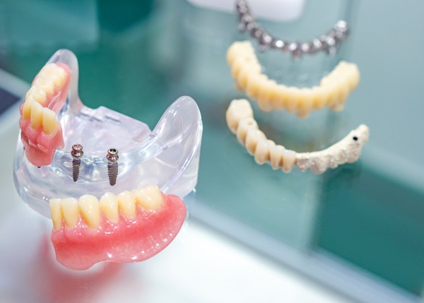 dental-implants/mini-dental-implants/