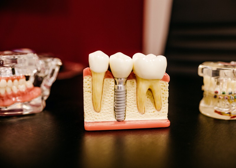 removable-dentures