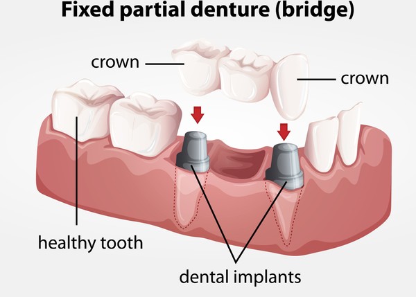 dental-implants/partial-fixed-bridge/