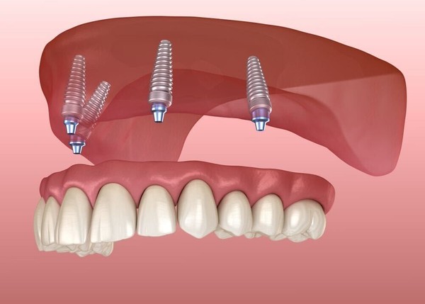 dental-implants/all-on-4-6/