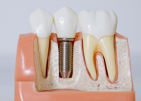 dental-implants/single-tooth/