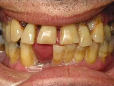 dental implants pictures before